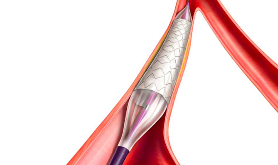 Lifestream Balloon Expandable Vascular Covered Stent