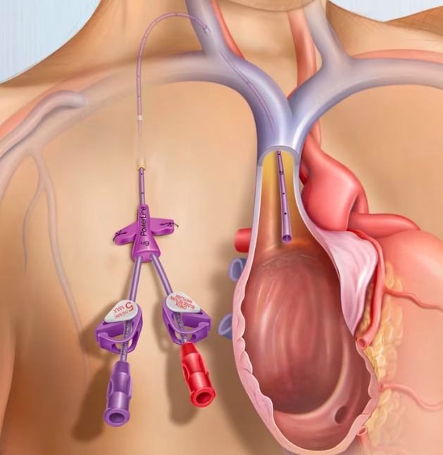 PowerLine™ Central Venous Catheter - Image 2