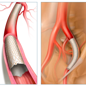 Covera Plus Vascular Covered Stent